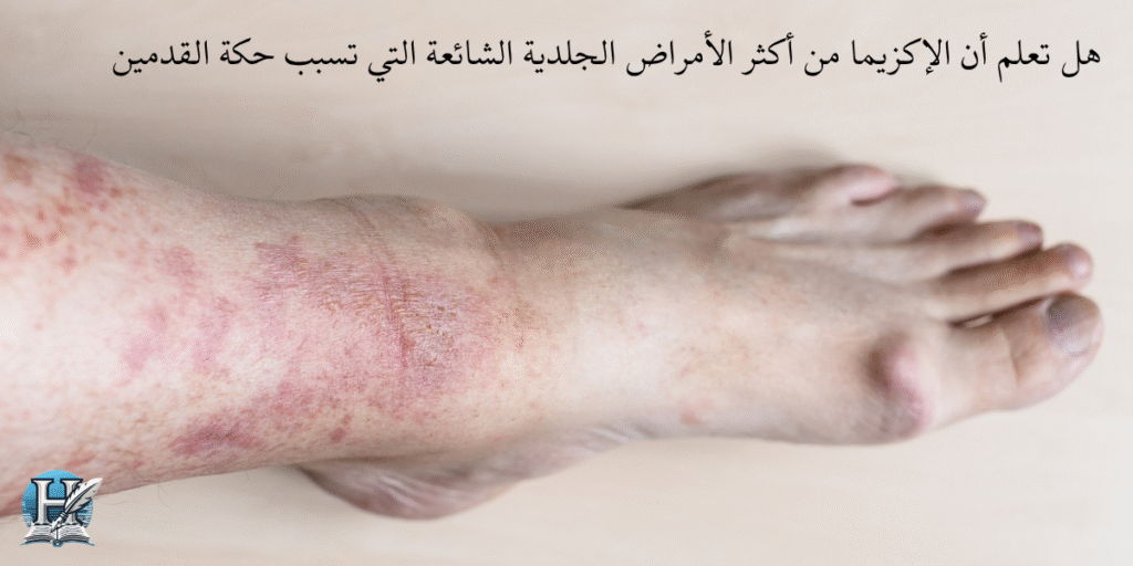 الأكزيما وعلاقتها بحكة القدمين
