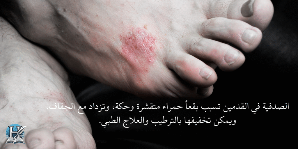 الصدفية بالقدمين