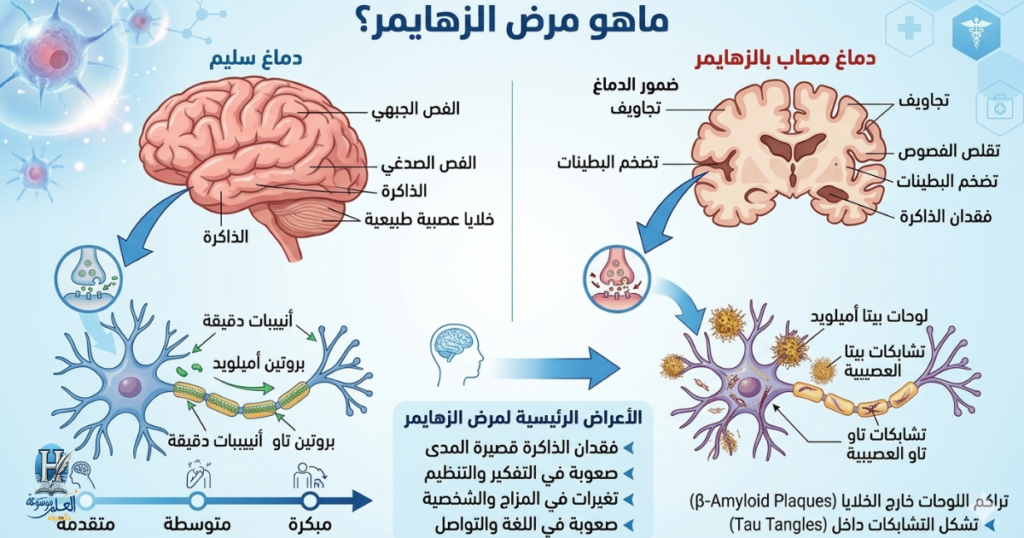مقارنة علمية تبرز الفرق بين الدماغ السليم والمصاب، موضحاً ضمور الأنسجة وتشكل اللويحات المسببة لتراجع القدرات الذهنية.